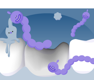 Bacterial change the sugar to be fermented then produce acid which erode & cause cavity